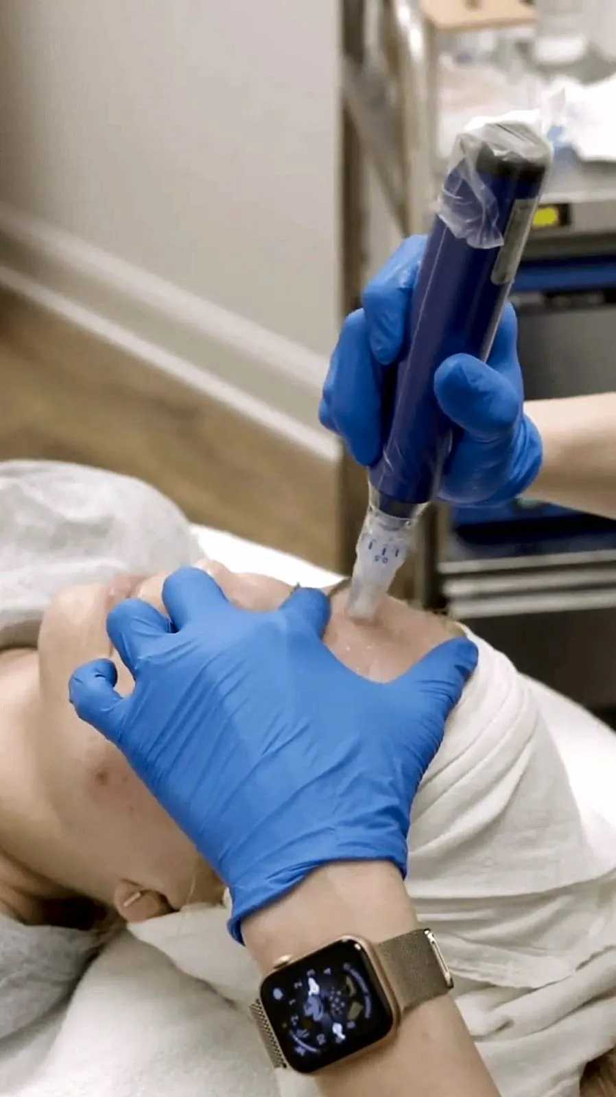 Microneedling